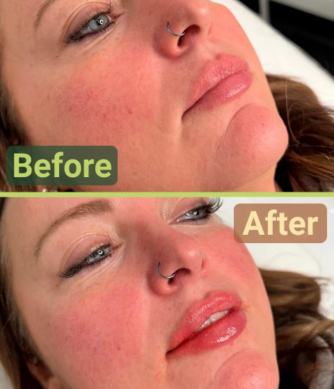 self care beauty and wellness - before and after filler treatments