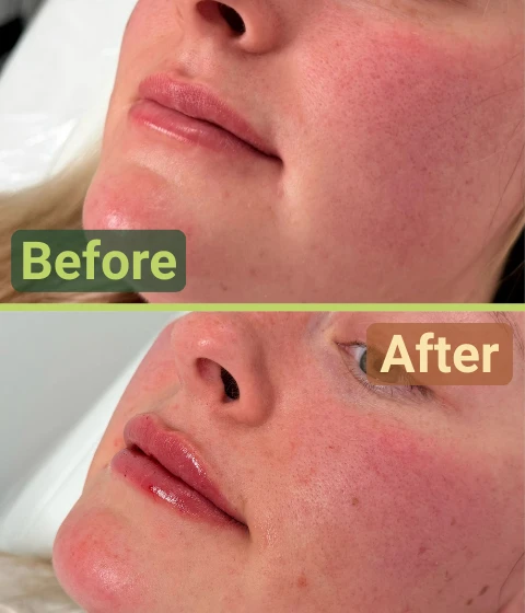 self care beauty and wellness - before and after filler treatments