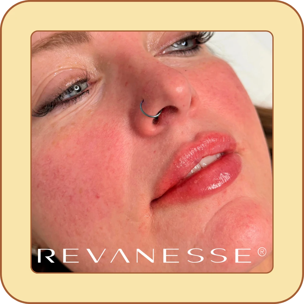 self care beauty and wellness - filler injections